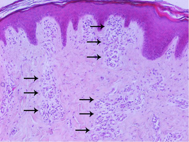 Histopathologische Untersuchung der Haut: vermehrte Vaskularisation hauptsächlich der oberflächlichen und mittleren Dermis.