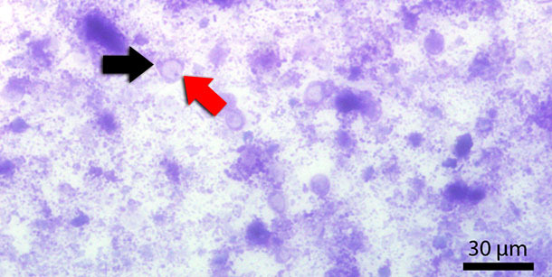 Kotausstrich mit Diff-Quick gefärbt. Der rote Pfeil zeigt auf die zentrale Vakuole. Der schwarze Pfeil zeigt auf den Zellkern
