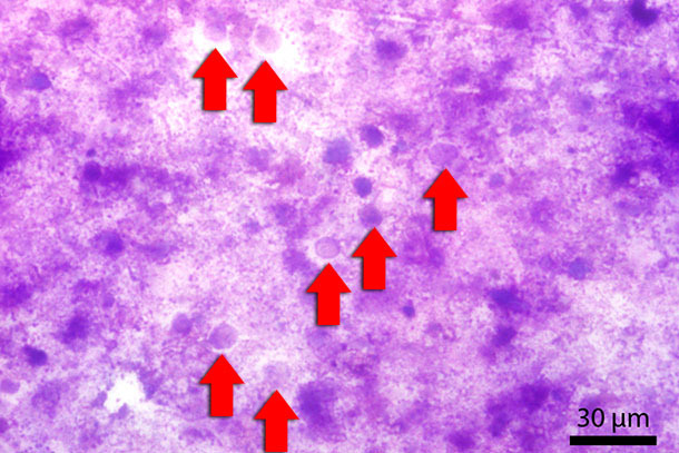 Kotausstrich mit Diff-Quick gefärbt. Die roten Pfeile zeigen auf Blastocystis-Stadien