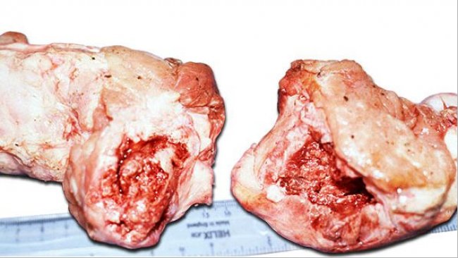 Ganzer Oberschenkelkopf am oder unter dem Knochenende gebrochen, mit Schwellungen um die Frakturstelle aufgrund einer Knochenhautentzündung.