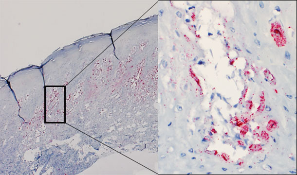 Skin biopsy of a vesicle from an affected pig