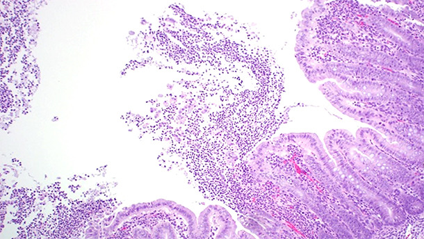 Abbildung 2: Histopathologische Untersuchungen von erkrankten Tieren zeigten eine multifokale bis lokal ausgedehnte fibrinopurulente Colitis ulcerosa.
