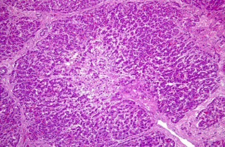 Zentrolobuläre Nekrose der Hepatozyten (Leberzellnekrose) und hochgradige Zerstörung der Leberstruktur mit mononukleärer Entzündung und Megalozyten.