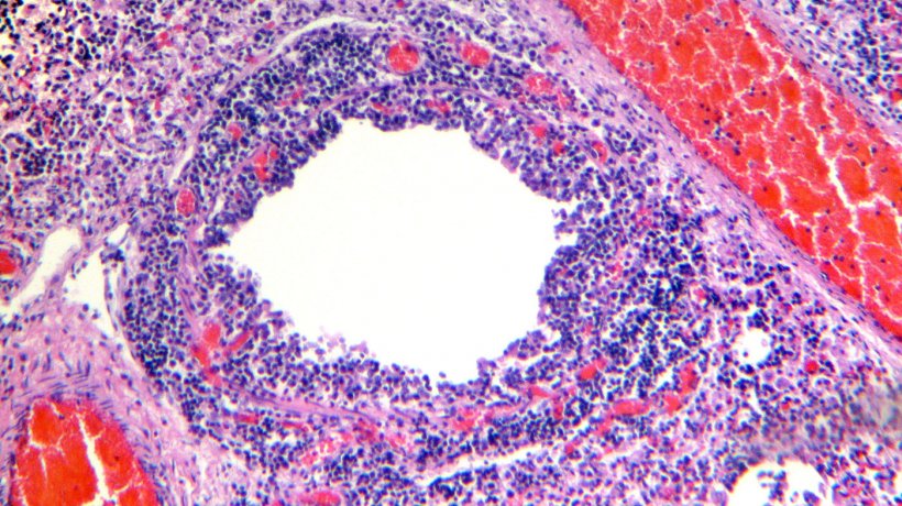 Abbildung 4: Bronchiole, die Desquamation und Nekrose des Atemwegsepithels, zusammen mit einer ausgepr&auml;gten lymphozytischen Infiltration der Lamina propia und der Tela submucosa aufweist.
