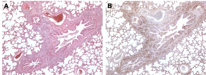 Abbildung 3: Mit M. hyopneumoniae und PCV2 koinfizierte Lunge eines Schweins A: Bereich der peribronchiol&auml;ren lymphatischen Hyperplasie, verursacht durch M. hyopneumoniae. B: Gro&szlig;e Mengen des PCV2-Antigens im Bereich der lymphatischen Hyperplasie.

