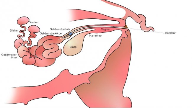 Abbildung 1: Bei der postzervikalen Besamung wird der Samen im Geb&auml;rmutterk&ouml;rper hinter dem Geb&auml;rmutterhals deponiert.
