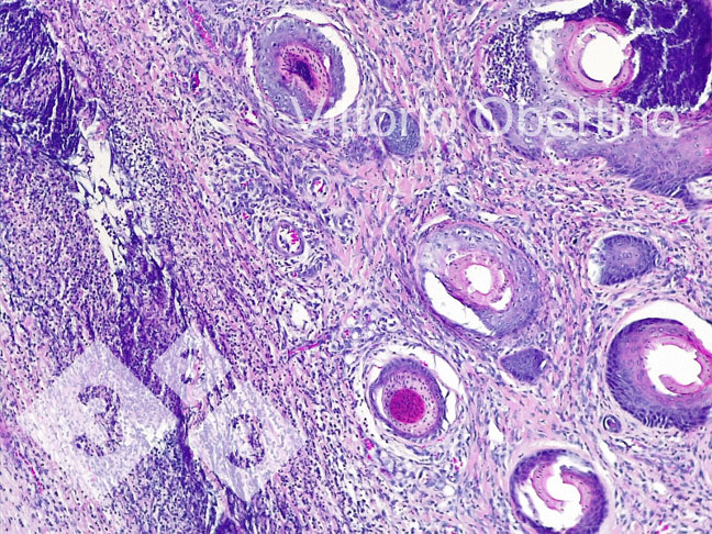 Abbildung 8: Nabel: Lokal ausgedehnter Hautbereich, der Fibroplasie mit aktivierten Fibroblasten und zahlreichen unreifen kleinen Gef&auml;&szlig;en (neu gebildetes Granulationsgewebe) sowie multifokales entz&uuml;ndliches Infiltrat mit &uuml;berwiegend lymphoplasmazellul&auml;ren Zellen aufweist. In einigen Gef&auml;&szlig;strukturen findet sich ein granulozyt&auml;res entz&uuml;ndliches Infiltrat, das die Gef&auml;&szlig;wand umgibt und fokal infiltriert (leukozytoklastische Vaskulitis).
