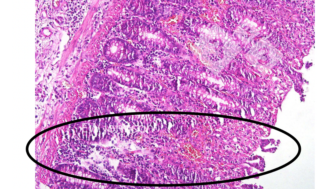 <p>Foto 4: Gef&auml;&szlig;thrombose, Infarkt und Ulzeration in der Dickdarmschleimhaut</p>
