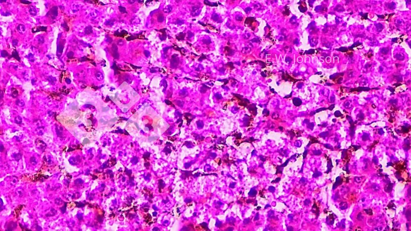 Abbildung 4: Fokale Lebernekrose mit gelegentlichen amphophilen intranukle&auml;ren Einschl&uuml;ssen in der peri-nekrotischen Zone, Leber
