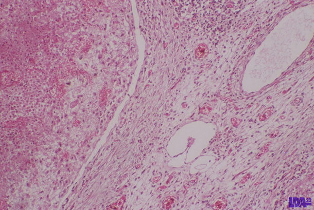 Nekrosen im Lymphknoten bei einem mit PCV2 infizierten Ferkel