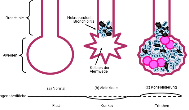 Bronchiolen