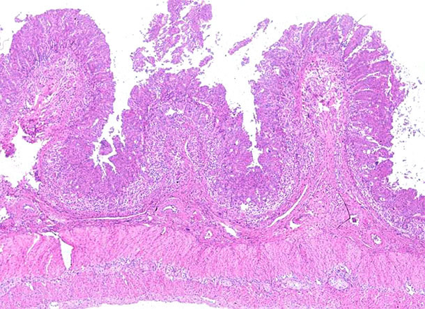 Ileum: Ausgeprägte Lymphozytendepletion und granulomatöse Entzündung der Peyer-Plaques im Ileum eines Schweins, das von der PCV2-bedingten systemischen Erkrankung betroffen ist. Hämatoxylin-Eosin-Färbung.