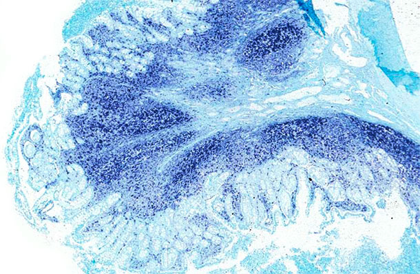 Ileum: Dasselbe Ileum des von der PCV2-bedingten systemischen Erkrankung betroffenen Schweins zeigt große Mengen des PCV2-Genoms in den Peyer-Plaques und in der Darmschleimhaut. In-situ-Hybridisierung zum Nachweis von PCV2: schnelle grüne Gegenfärbung.