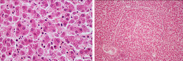 Desorganisation und diffuse, ballonierende Degeneration der Hepatozyten