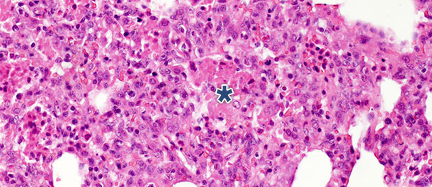 Intraalveolärer nekrotischer Debris und Akkumulation von Entzündungszellen (Sternchen) im Lungengewebe 10 Tage p. i. mit PRRSV Typ 1 Subtyp 1 Isolat.